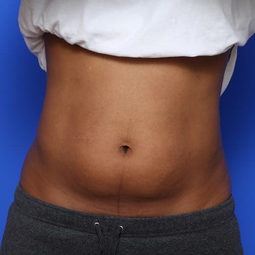 before & after coolsculpting
