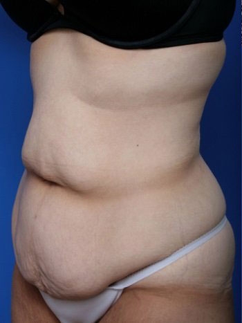 Body Contouring Surgery Cost