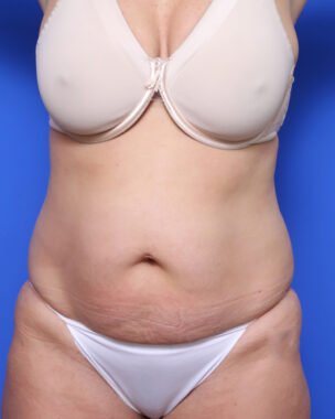 Case # 5 before photo