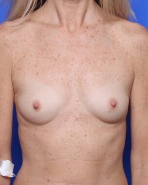 Case # 7 before photo