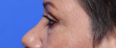 Case # 2 after photo