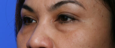 Case # 9 before photo