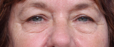 Case # 10 before photo