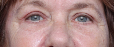 Case # 10 after photo