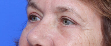 Case # 10 after photo