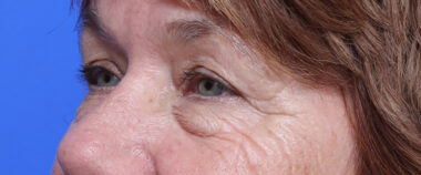 Case # 10 before photo