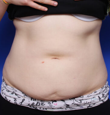 Case # 19 after photo