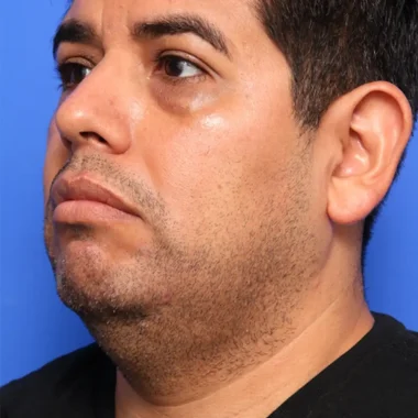 Case # 1 before photo