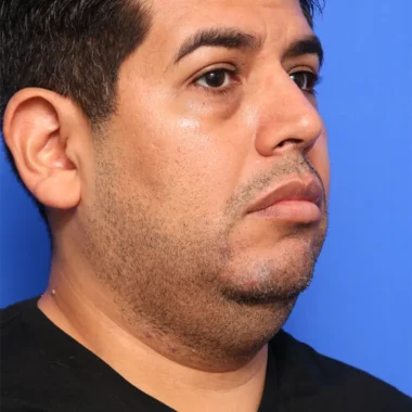 Case # 1 before photo