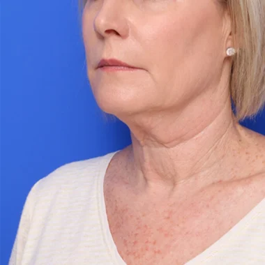 Case # 2 before photo