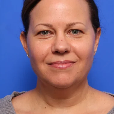 Case # 4 before photo