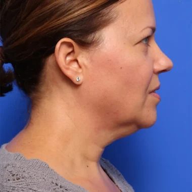 Case # 4 before photo