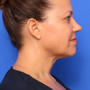 Case # 4 after photo