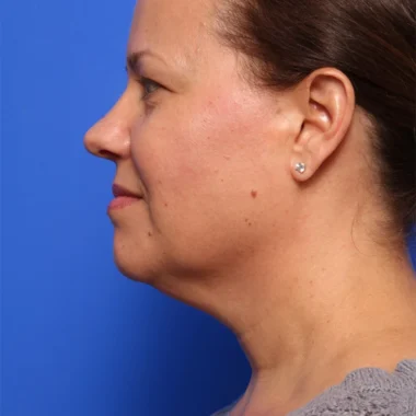 Case # 4 before photo