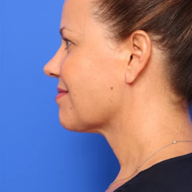 Case # 4 after photo