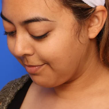 Case # 5 after photo