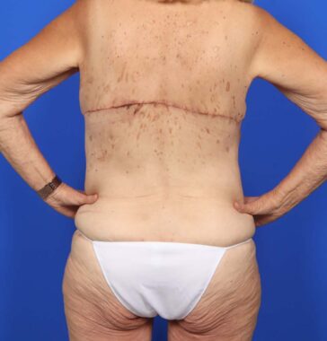 Case # 4 after photo