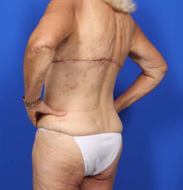 Case # 4 after photo