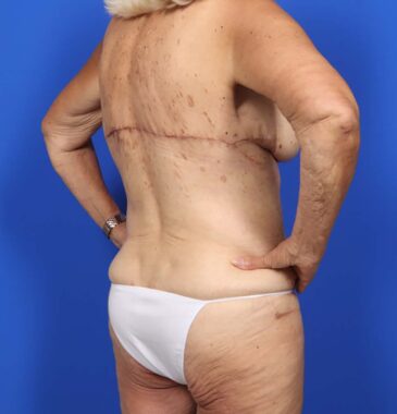 Case # 4 after photo