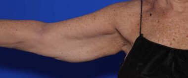 Case # 9 before photo