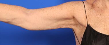 Case # 9 after photo