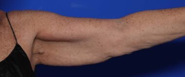 Case # 9 before photo