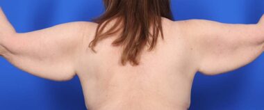 Case # 10 before photo