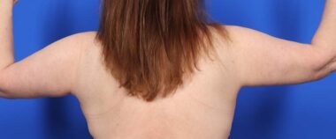 Case # 10 after photo