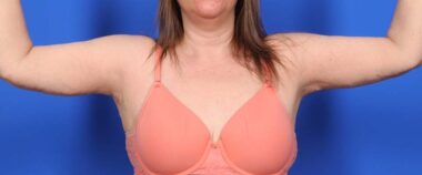 Case # 11 after photo