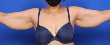 Case # 12 before photo