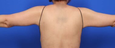 Case # 12 after photo