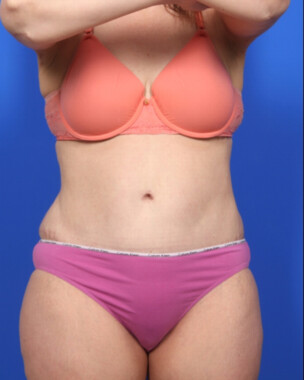 Case # 54 after photo