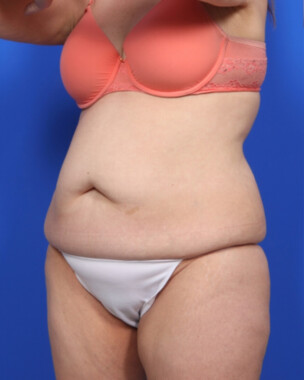 Case # 54 before photo