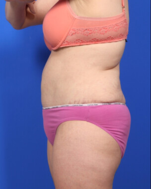 Case # 54 after photo