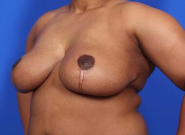 Case # 12 after photo