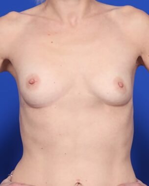 Case # 35 before photo