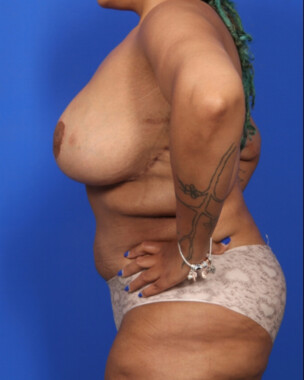 Case # 1 after photo