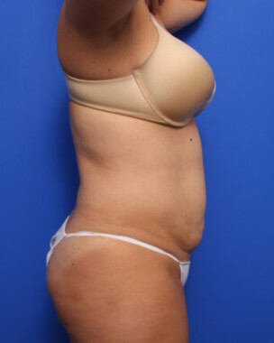 Case # 57 before photo