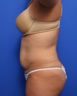 Case # 57 before photo