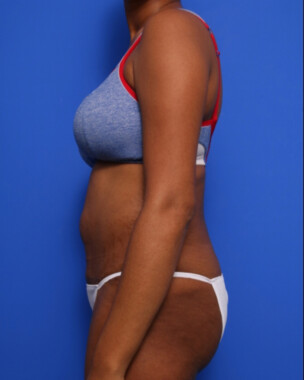 Case # 58 after photo