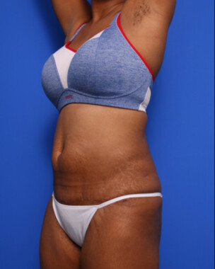 Case # 58 after photo