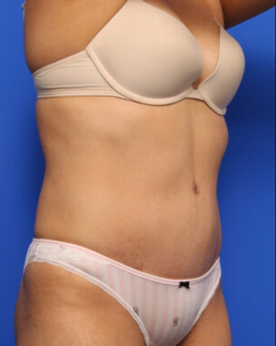 Case # 60 after photo