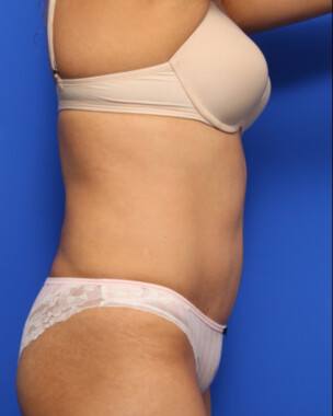 Case # 60 after photo