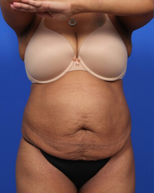 Case # 61 before photo