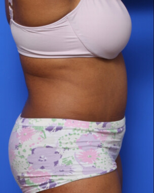 Case # 62 after photo