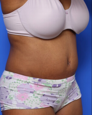 Case # 62 after photo