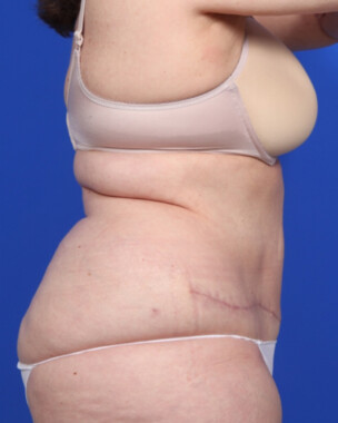 Case # 65 after photo