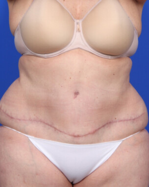 Case # 65 after photo