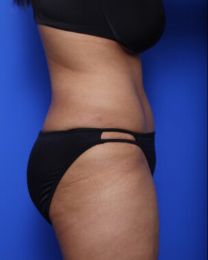 Case # 68 after photo