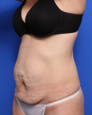 Case # 69 before photo